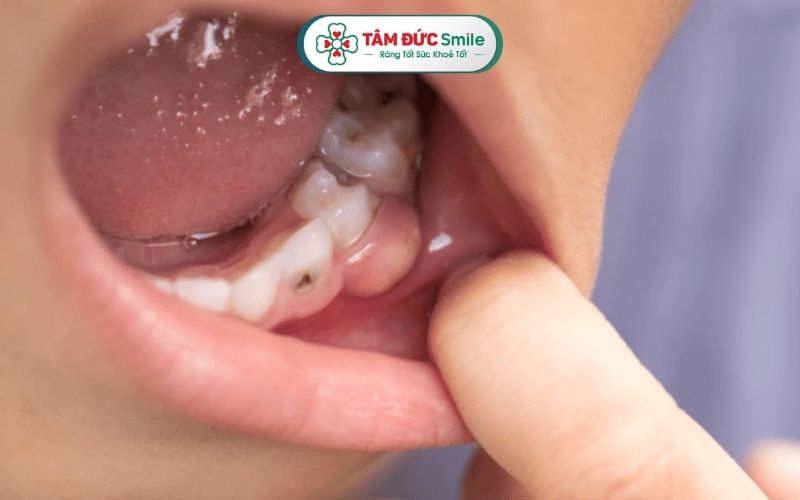Sưng mộng răng là tình trạng nướu bị sưng phồng, đỏ, dễ chảy máu