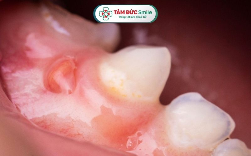 Tình trạng sưng mộng răng có thể bắt nguồn từ nhiều nguyên nhân khác nhau