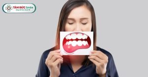 Sưng mộng răng là tình trạng nướu bị sưng phồng, đỏ, dễ chảy máu