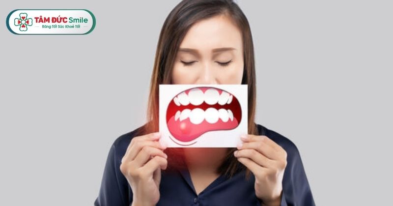 Sưng mộng răng là tình trạng nướu bị sưng phồng, đỏ, dễ chảy máu