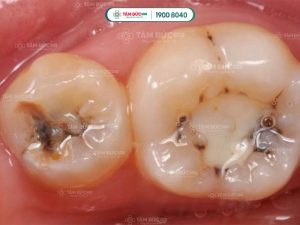 Thai kỳ làm cho răng yếu đi và dễ bị sâu hơn