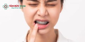    Niềng răng sai cách có thể gây ra một vài tác dụng phụ ngoài ý muốn