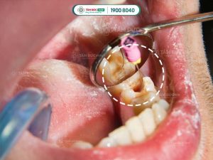 Lấy tuỷ răng lần 1 vẫn đau do còn sót ống tuỷ bị viêm