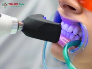 Tẩy trắng răng có hại không? 