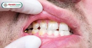 Thiểu sản men răng là một dạng rối loạn phát triển xảy ra trong quá trình hình thành men răng