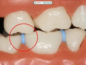 Thun tách kẽ là các vòng tròn cao su được sử dụng trong lúc chuẩn bị niềng răng