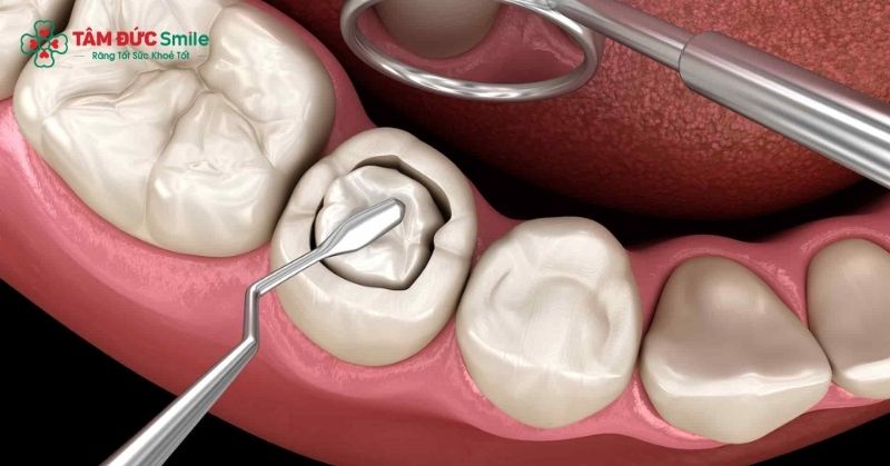 Trám răng composite là phương pháp phục hình răng thẩm mỹ sử dụng Composite thẩm mỹ có màu sắc tương đồng màu răng thật