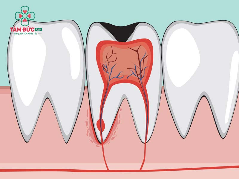 Viêm tuỷ làm đau nhức răng dữ dội