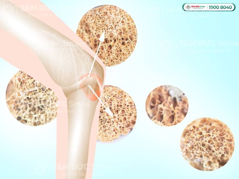 Thiếu vitamin D có thể gây còi xương ở trẻ em, loãng xương và suy giảm sức khỏe ở người trưởng thành.