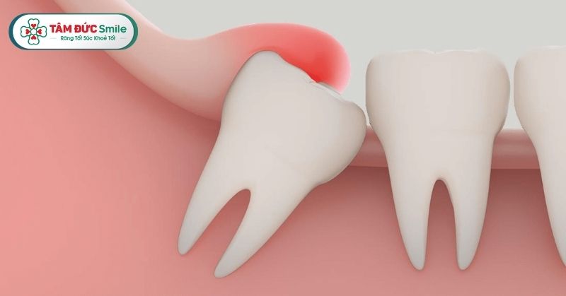 Viêm lợi trùm răng khôn là hiện tượng khá phổ biến ở người trong độ tuổi từ 17-25