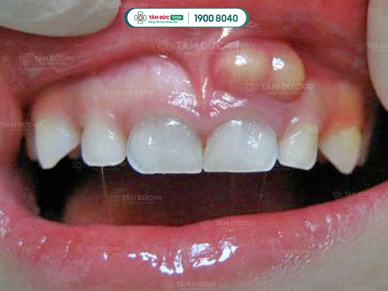 Miễn dịch kém dễ kéo theo các viêm nhiễm ở răng miệng