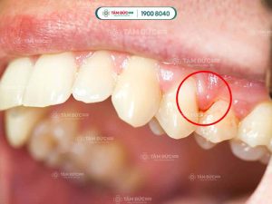 Người bị bệnh tiểu đường dễ bị viêm nướu và rất lâu lành