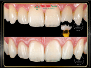 phương pháp hàn trám răng bằng vật liệu Composite sẽ giúp phục hồi hình dáng và chức năng tự nhiên