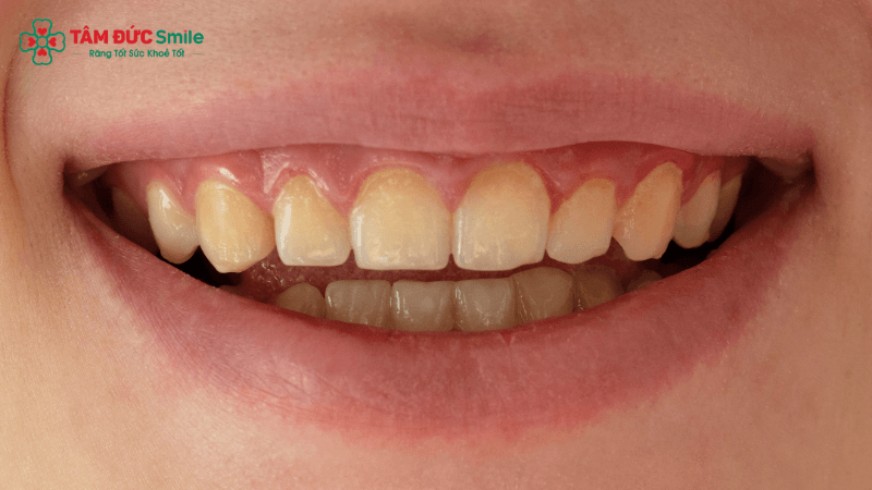 Bác sĩ Nha khoa Tâm Đức Smile thăm khám, đánh giá tình trạng răng để tư vấn chỉ định bọc sứ phù hợp.