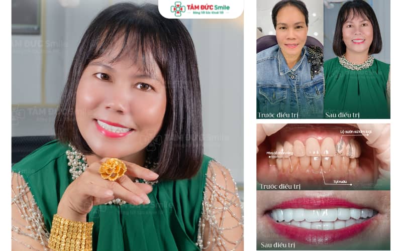 Bọc răng sứ tại Nha khoa Tâm Đức Smile Ninh Kiều – Nụ cười trắng sáng, tự tin