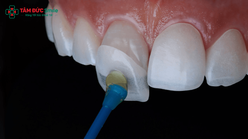 Mặt dán sứ Veneer siêu mỏng giúp cải thiện màu sắc và hình thể răng, đồng thời ưu tiên bảo tồn răng thật tại Nha khoa Tâm Đức Smile.