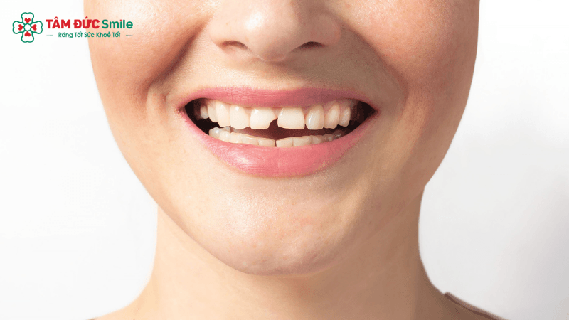Dán sứ Veneer tại Nha khoa Tâm Đức Smile phù hợp với nhiều trường hợp răng ố vàng, thưa nhẹ, sứt mẻ nhẹ hoặc hình thể răng chưa cân đối.