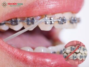 Dây thun niềng răng được sử dụng để tăng lực kéo và hỗ trợ quá trình chỉnh nha