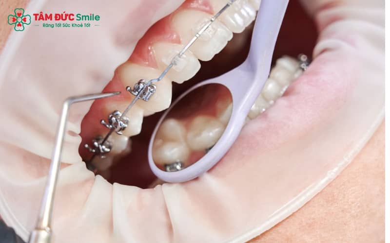 Gắn mắc cài là kỹ thuật sử dụng khí cụ chuyên dụng để cố định lên bề mặt răng