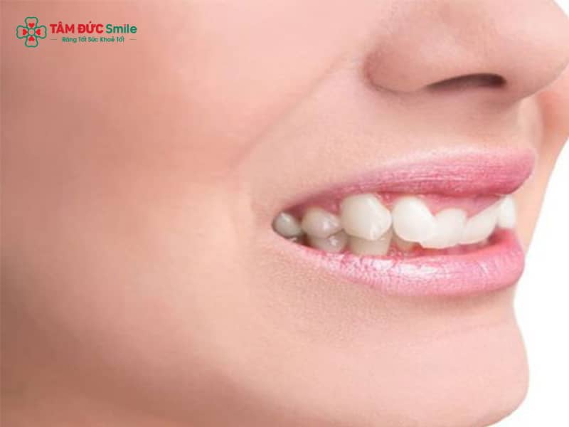 Lệch hàm: Nguyên nhân, dấu hiệu, chi phí và cách điều trị hiệu quả