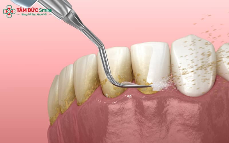 Cạo vôi răng giúp loại bỏ mảng bám, hỗ trợ bảo vệ răng và nướu.