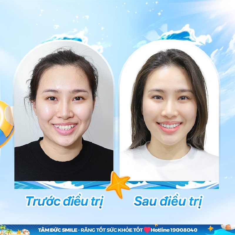 nieng-rang-binh-thanh-5
