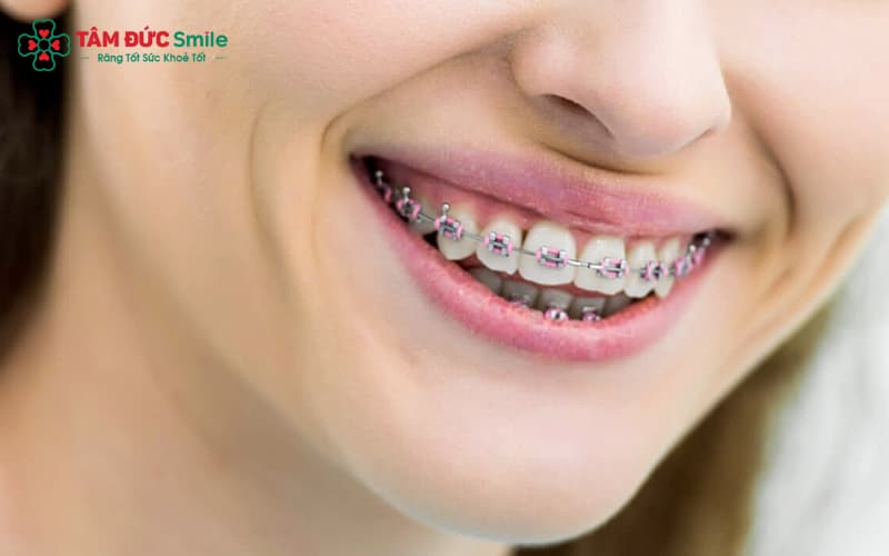 Niềng răng mắc cài kim loại giúp chỉnh răng phức tạp ở người lớn