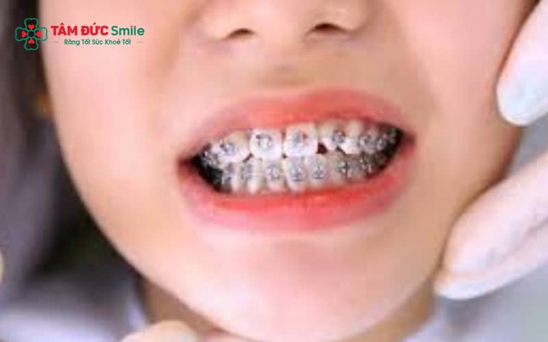 Tái niềng được chỉ định khi cần phục hồi thẩm mỹ và chức năng răng miệng