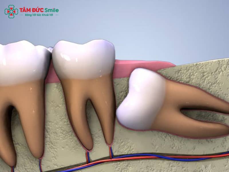 Niềng răng có cần nhổ răng khôn không? Tác động và chỉ định từ bác sĩ chỉnh nha
