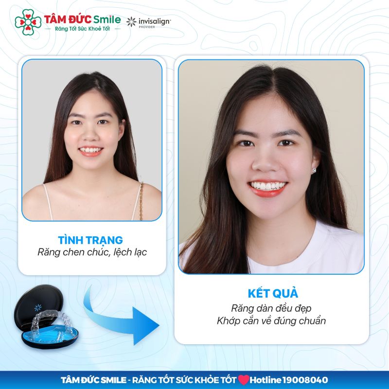 Niềng răng Invisalign có ưu điểm thẩm mỹ cao, tháo lắp linh hoạt và dễ vệ sinh khi điều trị tại Nha khoa Tâm Đức Smile.
