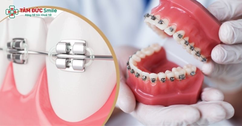 Niềng răng 3M UGSL là phương pháp chỉnh nha sử dụng hệ thống mắc cài 3M Unitek/Gemini SL