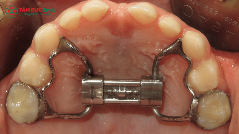 Gắn ốc nong và siết ốc định kỳ giúp mở rộng cung hàm an toàn, hiệu quả