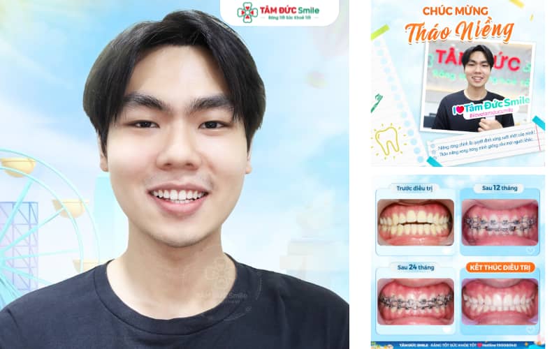Niềng răng mắc cài kim loại giúp răng đều đẹp với chi phí tối ưu