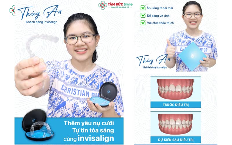Niềng răng Invisalign – giải pháp hiện đại, trong suốt và tiện lợi