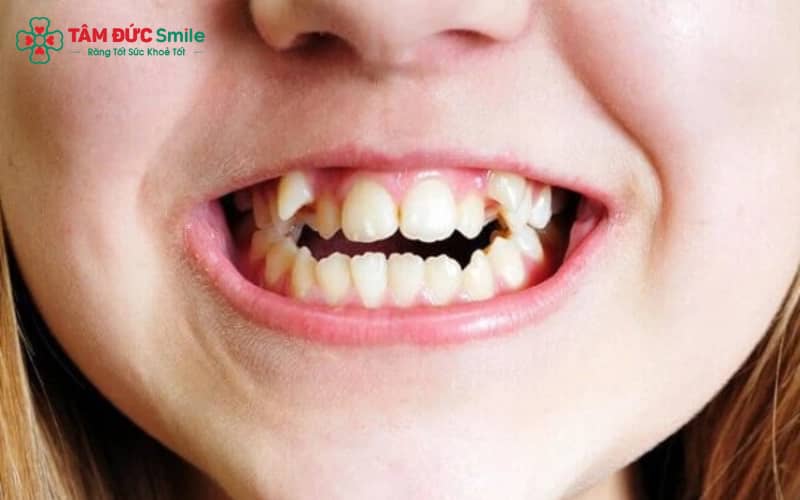 Răng nanh mọc lệch có thể làm sai lệch cấu trúc hàm và khớp cắn