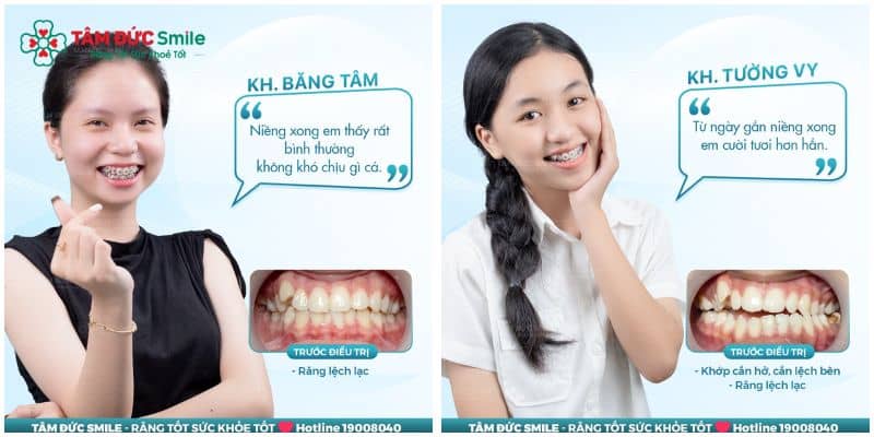 Thời gian chỉnh nha răng chen chúc trung bình kéo dài 18 – 30 tháng