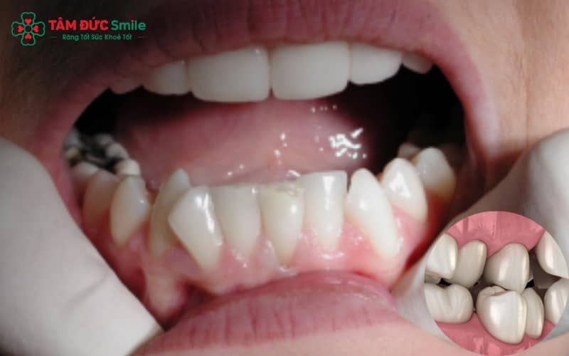 Răng chen chúc ảnh hưởng đến thẩm mỹ khuôn mặt, khớp cắn và sức khỏe răng miệng