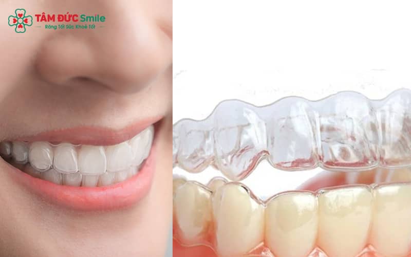 Niềng răng trong suốt Invisalign có tính thẩm mỹ, tiện lợi