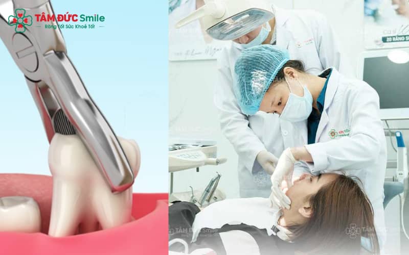 Nhổ răng tiền mol giúp tạo khoảng trống hỗ trợ điều trị răng chen chúc hiệu quả