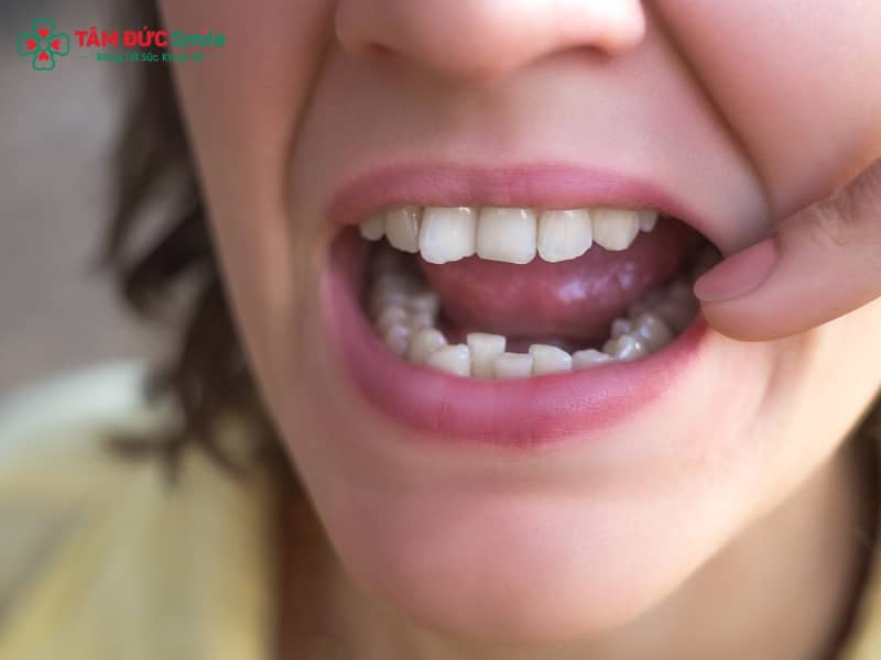 Niềng răng chen chúc – Giải pháp điều trị răng lệch lạc, khấp khểnh, sai khớp cắn