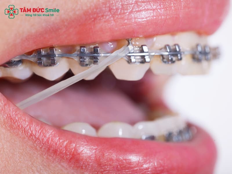 Báo ngay cho bác sĩ nếu bạn quên đeo thun liên hàm thường xuyên.