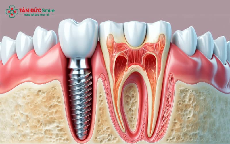 Cơ thể bắt đầu phản ứng sinh học ngay khi trụ Titanium/Zirconia được cấy vào xương hàm
