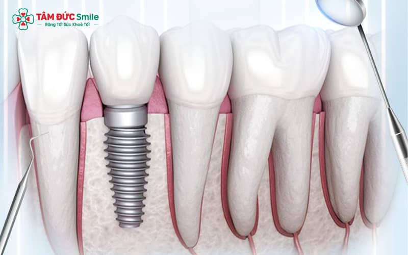 mplant được đánh giá là phương pháp trồng răng tiên tiến, an toàn và ổn định