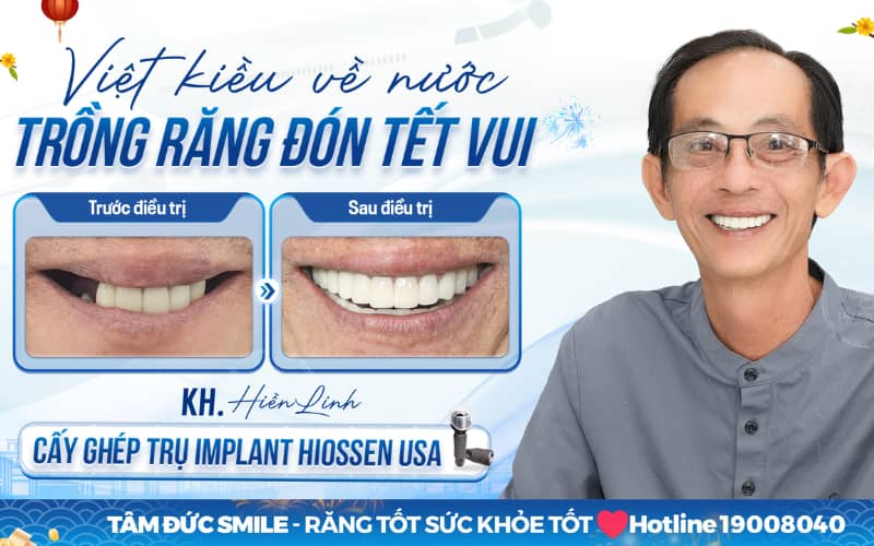 Trồng răng Implant giúp khôi phục thẩm mỹ, răng tự nhiên tại Nha khoa Tâm Đức Smile – Tân Bình