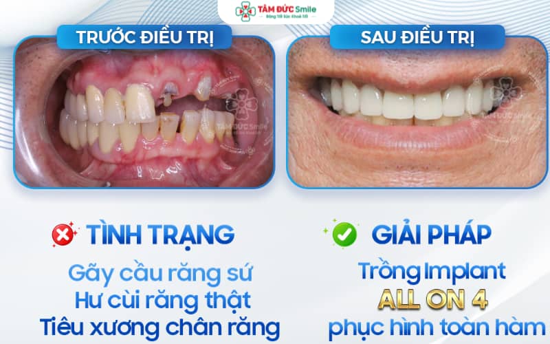 Cấy ghép Implant là kỹ thuật phục hình răng tiên tiến, an toàn và bền chắc