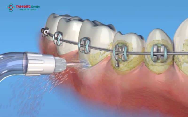 Trong thời gian niềng răng, máy tăm nước là công cụ lý tưởng giúp duy trì răng miệng sạch khỏe