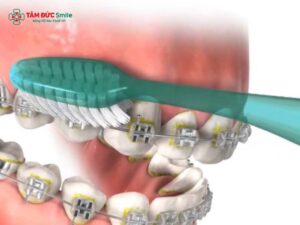Vệ sinh răng khi niềng: Cách chải răng, vệ sinh mắc cài, chỉ nha khoa hiệu quả