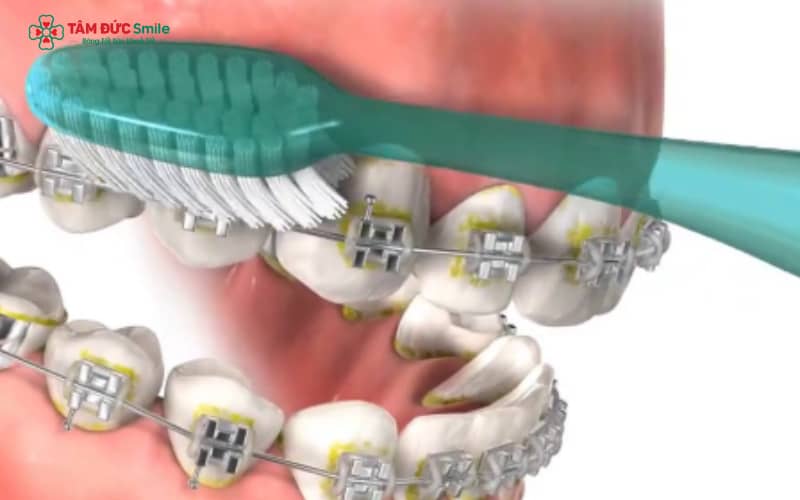 Bạn cần duy trì thói quen chải răng chuẩn khoa học ít nhất 2–3 lần/ngày