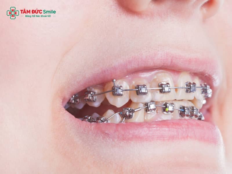 Bị móm có nên niềng răng? Niềng răng móm, Invisalign, mắc cài tự buộc hiệu quả