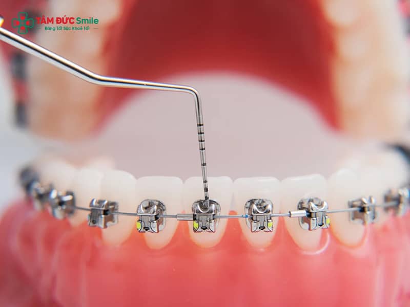 Các loại niềng răng: mắc cài kim loại, sứ, tự buộc, mặt trong, Invisalign